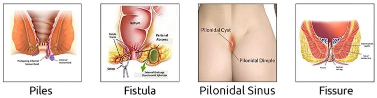 Diode Laser 1470nm 980nm Hemorrhoids Treatment Device Surgery Hemorrhoidectomy Device with CE