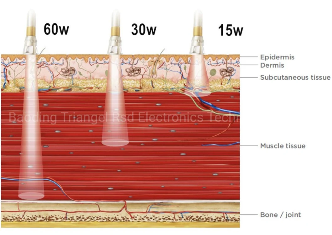 High Effective 980nm Diode Laser Equipment for Pain Relief Physiotherapy Physical Therapy