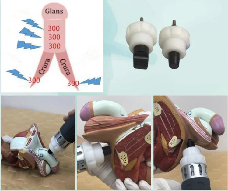 Shockwave Erectile Dysfunction Retatment Equipment for ED Shock Wave Therapy Device