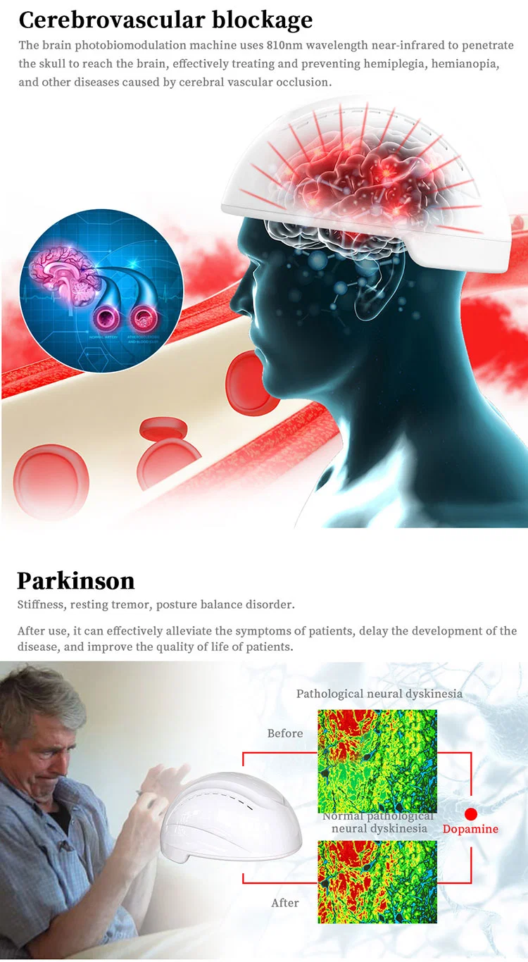 Transcranial Low Level Laser Therapy Neuro Brain Photobiomodulation System