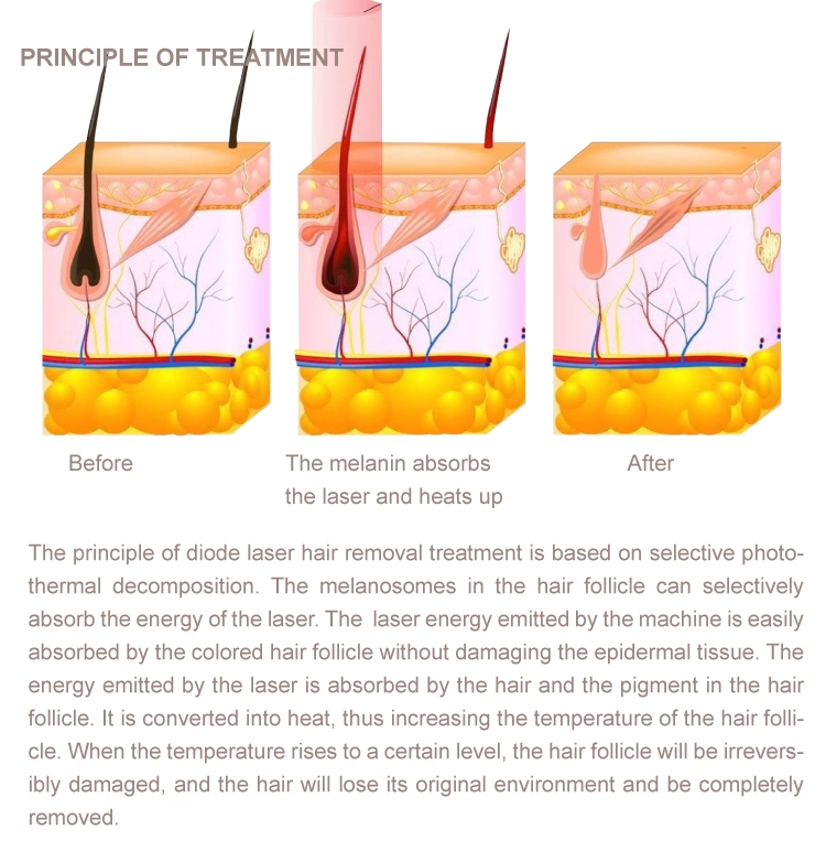 Ama Cold 3 Wavelength 755 808 1064nm Portable Mini Diode 3 in 1 Wavelength Laser Hair Removal Machine