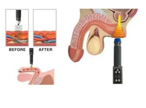 ED Treatemtn Pain Relief 3 in 1 Cet Ret Onde De Choc SA-Sw14 Magnetoterapia Shock Wave Therapy