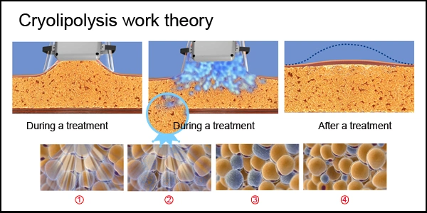 Acoustic Wave Therapy / Cryo Ultrasonic Cavitation Weight Loss Equipment