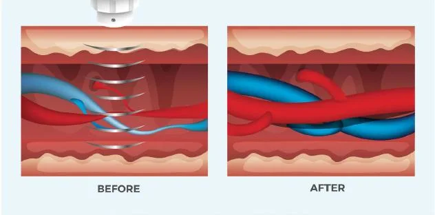 ED Treatemtn Pain Relief 3 in 1 Cet Ret Onde De Choc SA-Sw14 Magnetoterapia Shock Wave Therapy