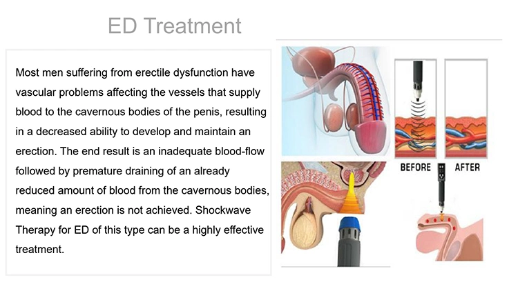 ED Treatemtn Pain Relief 3 in 1 Cet Ret Onde De Choc SA-Sw14 Magnetoterapia Shock Wave Therapy