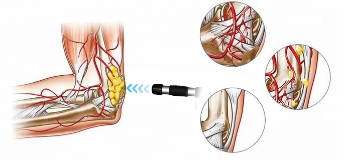 Eswt Pneumatic High Intensity Focused Shockwave Therapy Machine for Rehabilitation &amp; ED Treatment