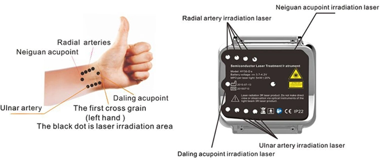 High Blood Fat Removal Medical Equipment 650nm Cold Laser Instrument