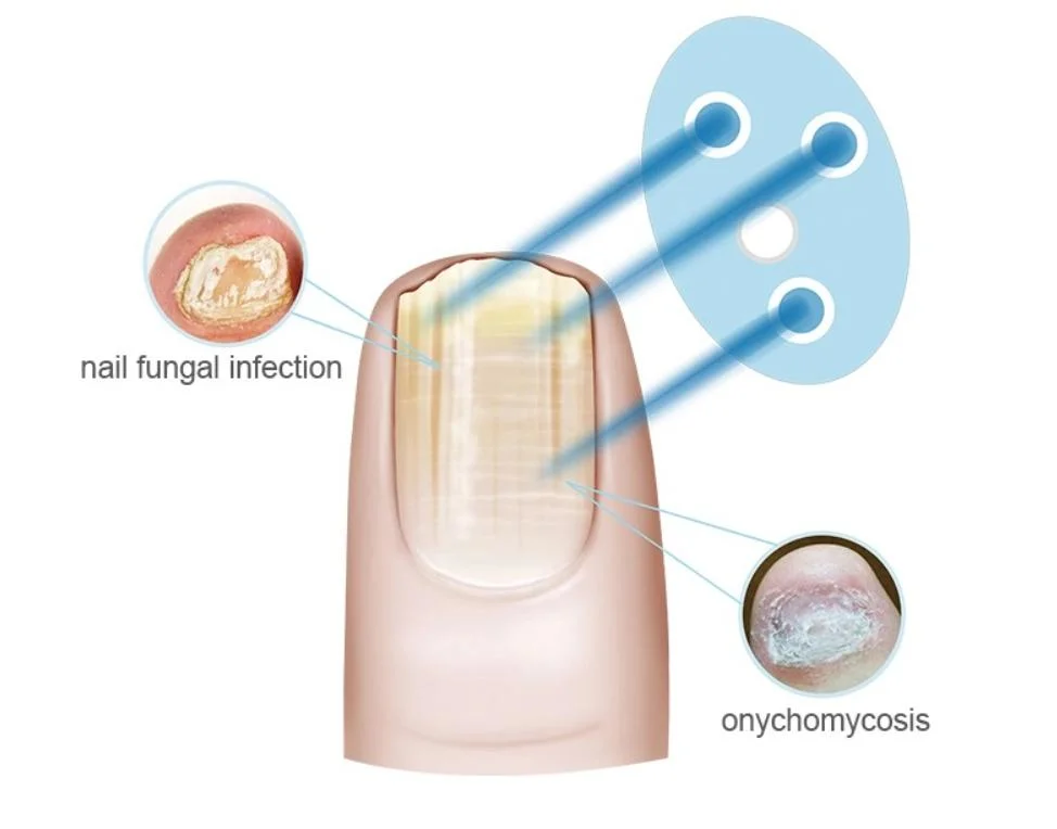 Cold Laser Cure for Toe Nail Fungus Anti Toenails Fungal Onychomycosis Therapeutic Equipment