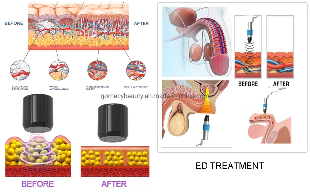 Physical Therapy Equipment Eswt Shockwave Therapy Machine for ED Treatment Pain Relief Sports Injury Recover Slimming