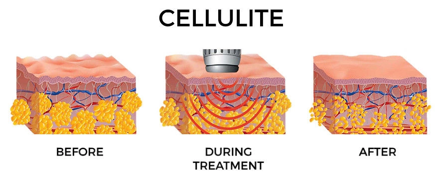 Multifunctional Acoustic Wave Therapy Machine Equipment for Fat / Cellulite Reduction