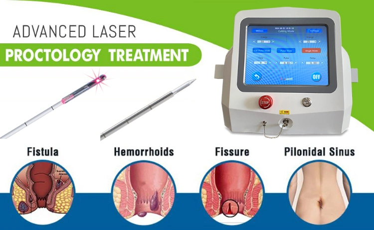 SMA905 Connector Medical Conical Hemorrhoids Fiber Fistulas Fissure Radial Fiber 600nm Optical Fiber 600um