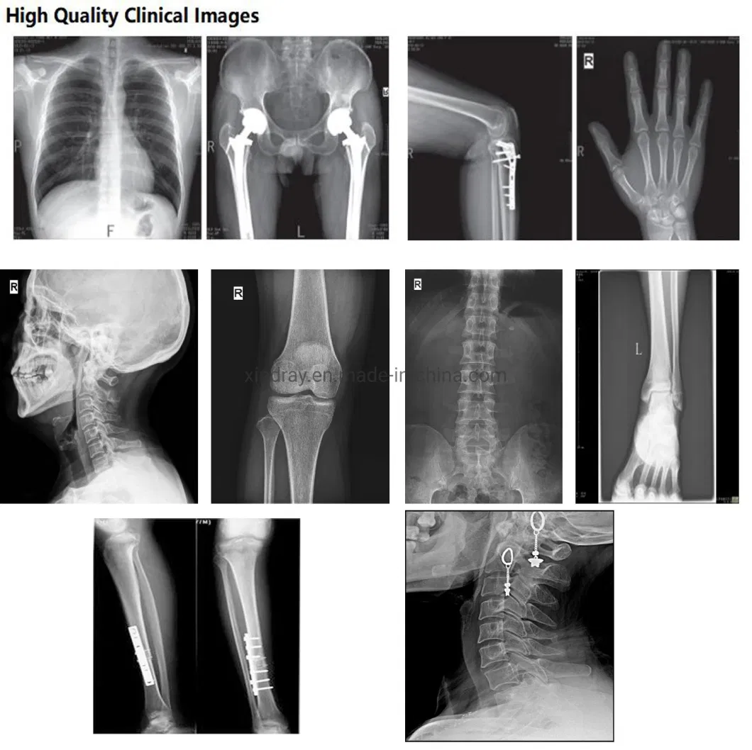 Mobile X-ray Machine with Medical Flat Panel Digital Radiography Control System