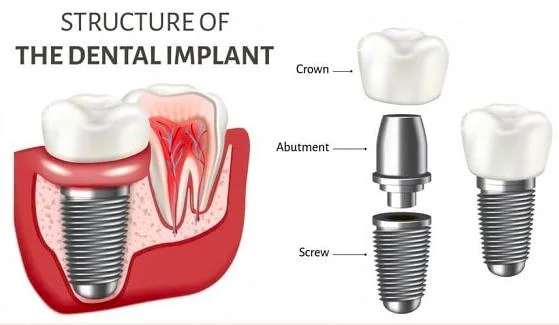 China Manufacturer of Teeth Implant Open Tray for Angels Dental Implant System