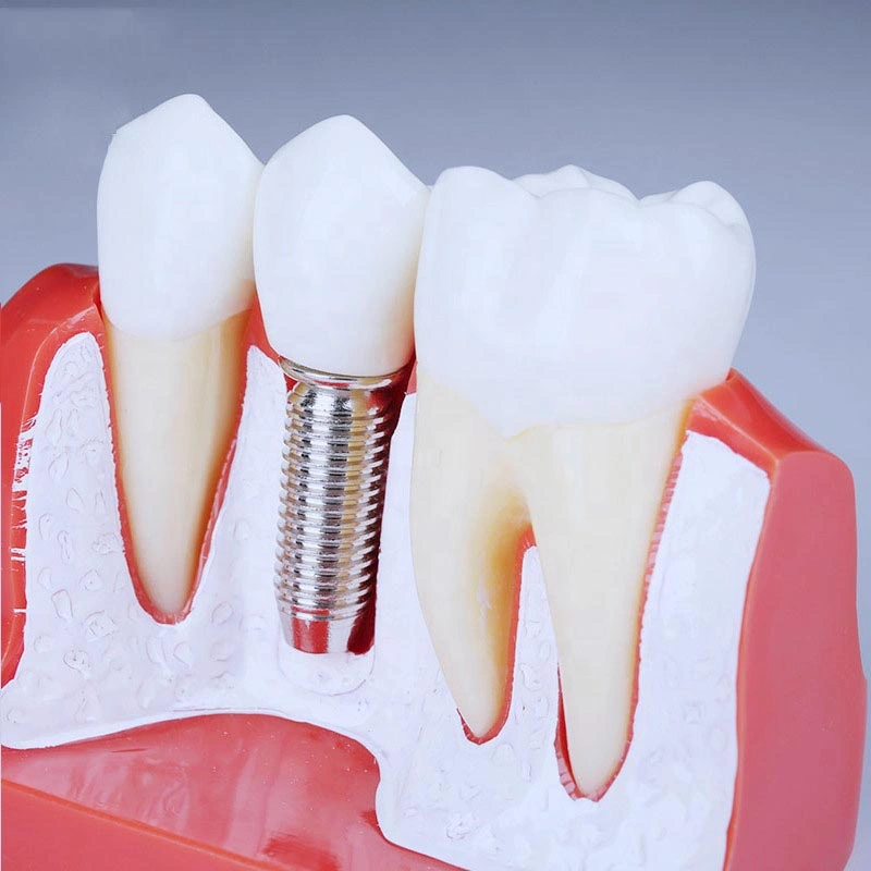 China Manufacturer Teeth Implant Open Tray Impression for Angels Bone Level Implant System