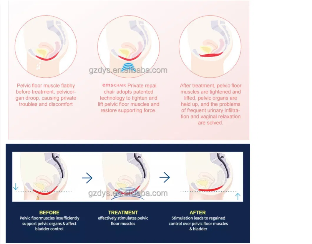 EMS Pelvic Restoration Prostate Conservation Chair Floor Muscle Abdominal High Quality Pelvic Floor Muscle Repair Chair