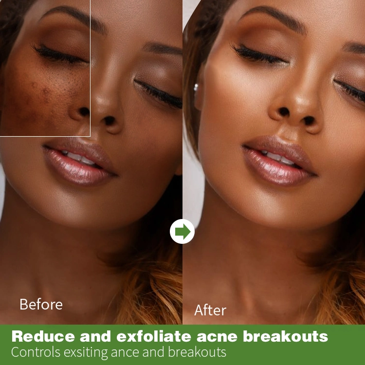 Ailke Wholesale Best Salycilic Acid Acne Pimple Face Brightening Acne Treatment Serum Facial