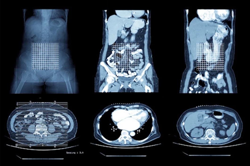 Sterile Breast Biopsy Lateral Grids Radiopaque Adhesive Tape