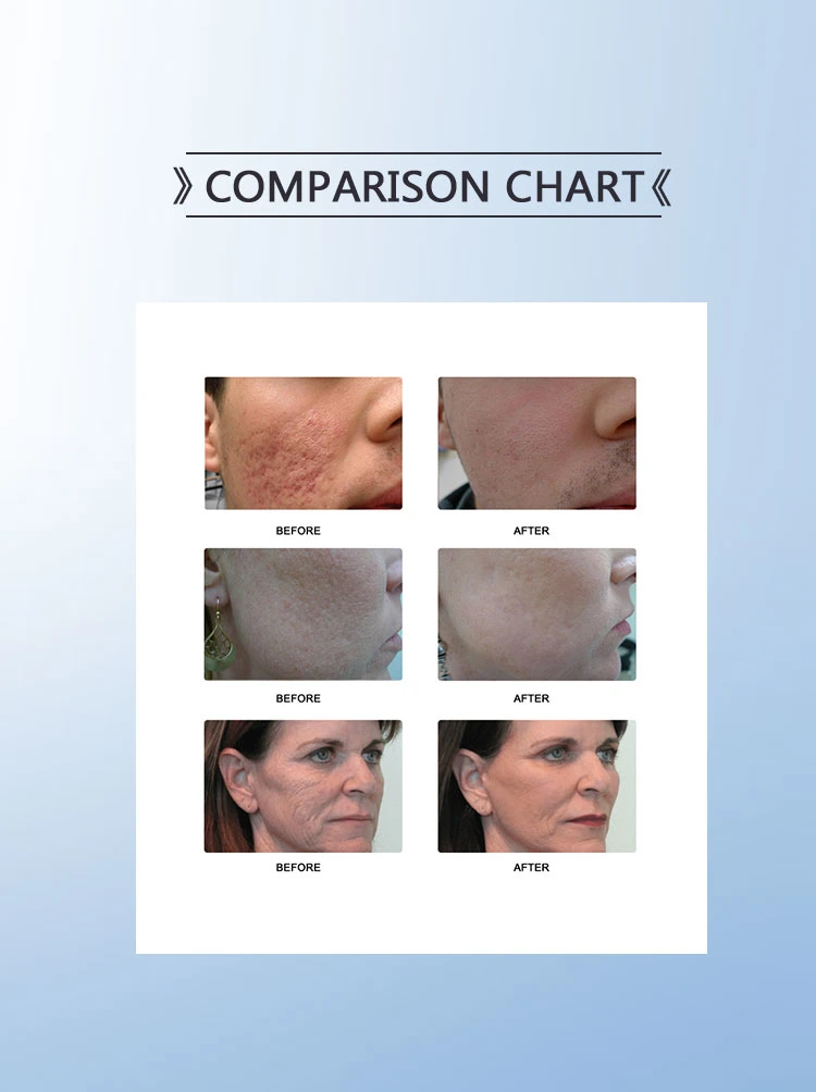 Fractional CO2 Laser Machine for Skin Resurfacing Scar Removal Vaginal Tightening