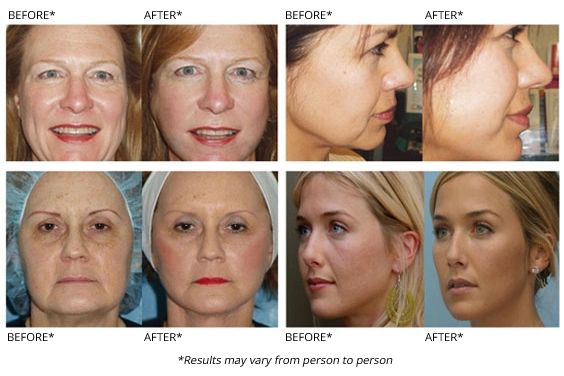 Authentication Safe Hyaluronic Acid Dermal Filler