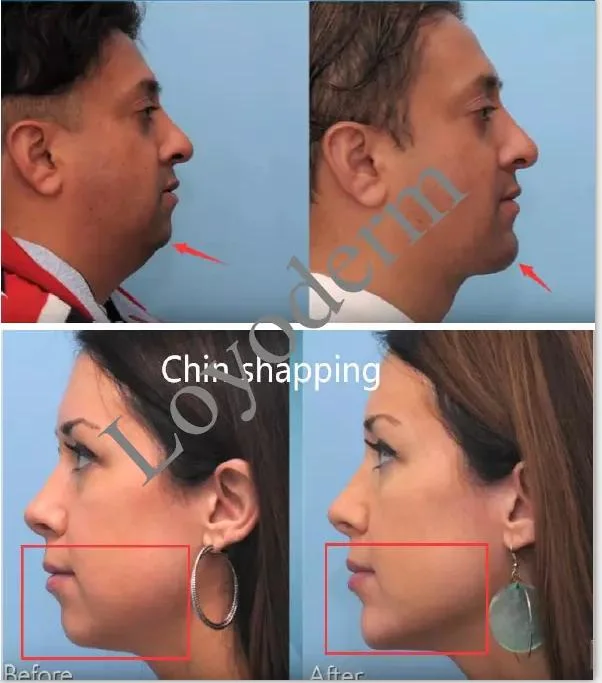 Authentication Safe Hyaluronic Acid Dermal Filler