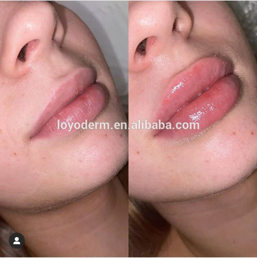 5ml Nasolabial Folds Authentication Hyaluronic Acid Dermal Filler