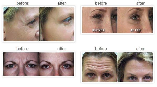 Authentication Safe Hyaluronic Acid Dermal Filler