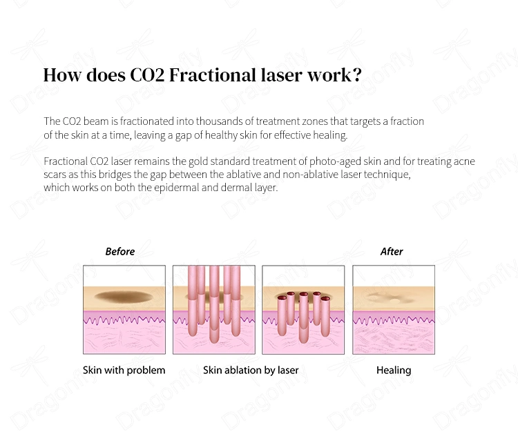 CE Medical CO2 Fractional Laser Machine for Acne Scar Stretch Mark Removal Fractional CO2 Laser Vaginal Tightening Machine