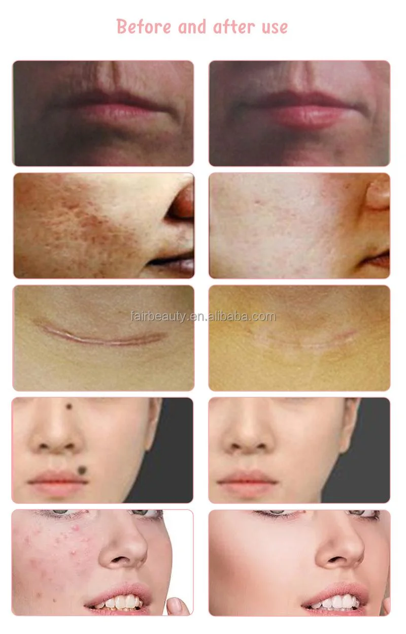 2023 Diode Laser Fat Reduction Stretch Marks Removal 1064nm Laser CO2 Fractional Skin Rejuvenation Beauty Machine