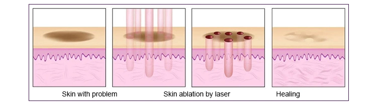 China Medical CO2 Laser Acne Scar Removal Stretch Marks Treatment Fractional Laser CO2 Fractional Laser Machine