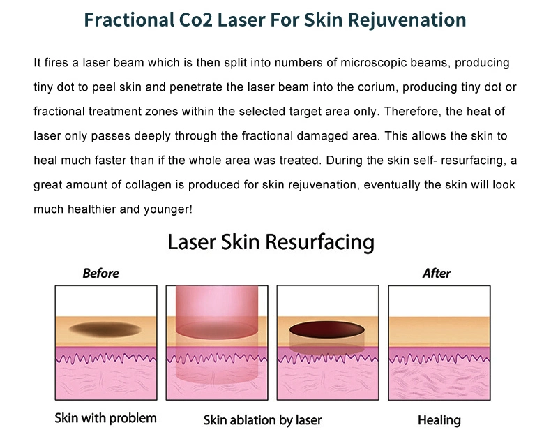 High Quality Fractional CO2 Laser Stretch Mark Removal Machine