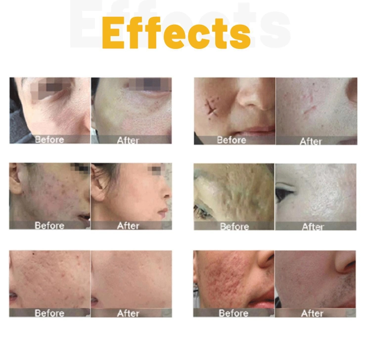 2023 Stretch Marks Acne Scar Removal CO2 Laser Machine RF Tube Skin Resurfacing CO2 Fractional Laser