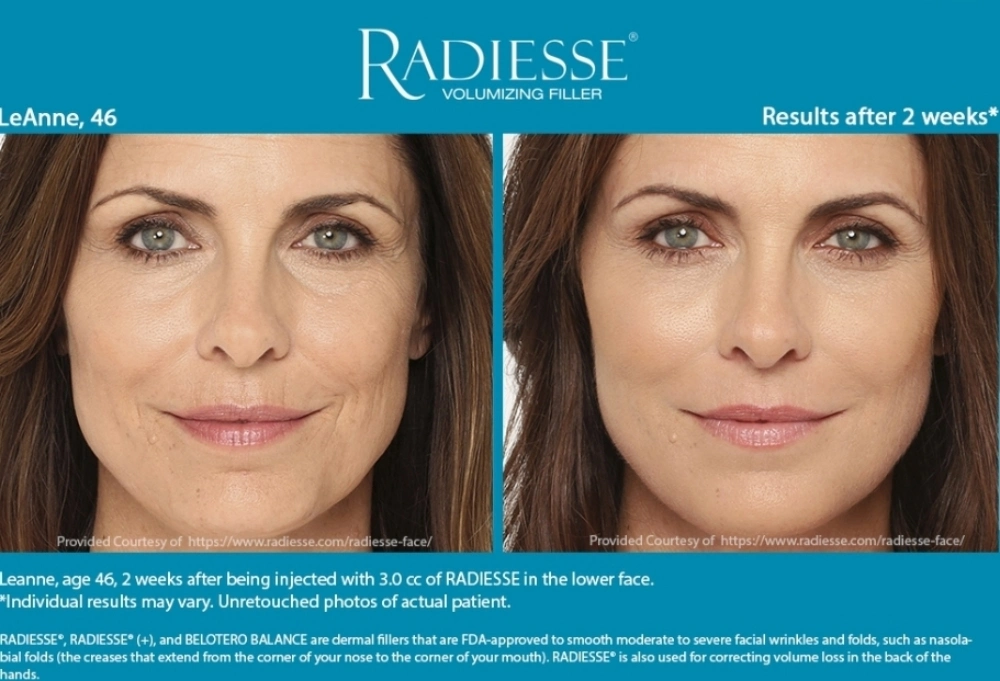 Radiesse Volassom Facetem Korean Filler Calcium Hydroxyapatite Filler for Wrinkle Removal