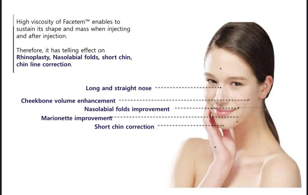 Radiesse Volassom Facetem Korean Filler Calcium Hydroxyapatite Filler for Wrinkle Removal