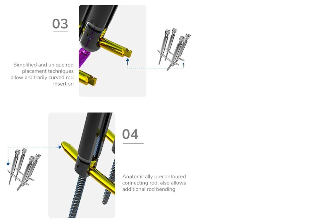 Made in China Mis Polyaxial Cannulated Pedicle Screw, Minimally Invasive Spinal System, Titanium, Orthopedic Implant, Surgical, Medical Instrument, with CE/ISO