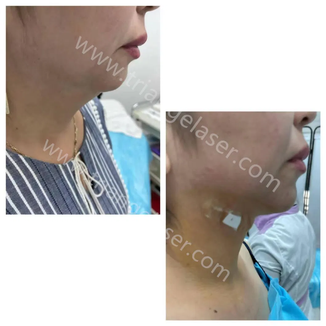 Liposuction Surgery and Fat Reduction Lipo Laser Slimming Machine
