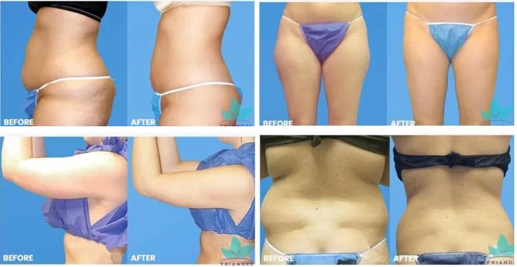 Liposuction Surgery and Fat Reduction Lipo Laser Slimming Machine