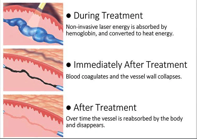 CE Approval Alex Laser 755nm 1064nm ND YAG Skin Cooling Conducted Laser Permanent Hair Removal Alexandrite Laser