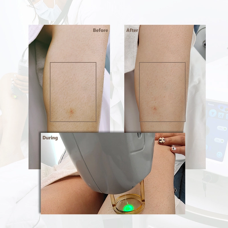 Alex Laser 755nm 1064nm Alexandrite YAG Nitrogen Let Skin Cooling Conducted Laser Permanent Hair Removal Alexandrite Laser