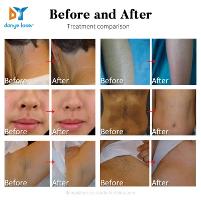 2021 High Power 600 Watt Tripal Wavelength Laser Hair Removal Device Pain Free Hair Remover