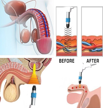 Super Handle Deep Electromagnetic Focused Shockwave Therapy Machine