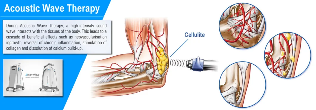 Acoustic Wave Focused Shockwave Therapy Equipment for Body Beauty