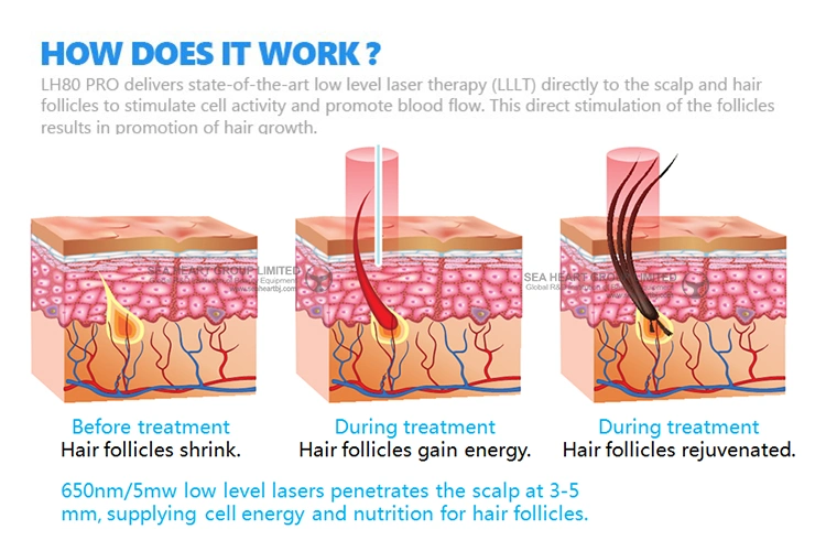 Hair Care Therapy Anti-Hair Loss Laser Hair Regrowth Helmet