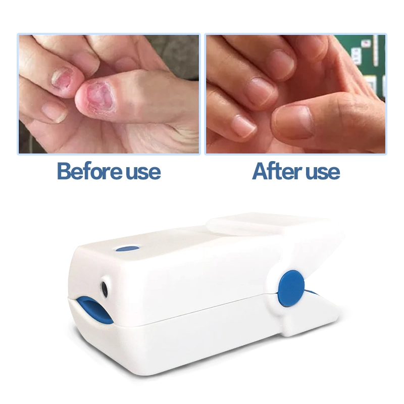 950nm Lllt Nail Fungus Laser Treatment Device for Toe Fungus Nail Fungal Laser Therapy Device