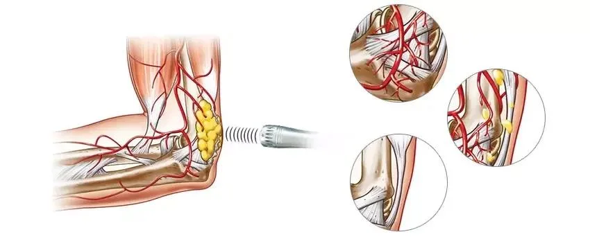 Low Intensity Extracorporeal Shockwave ED Erectile Dysfunction Therapy Machine Penis Enlargement