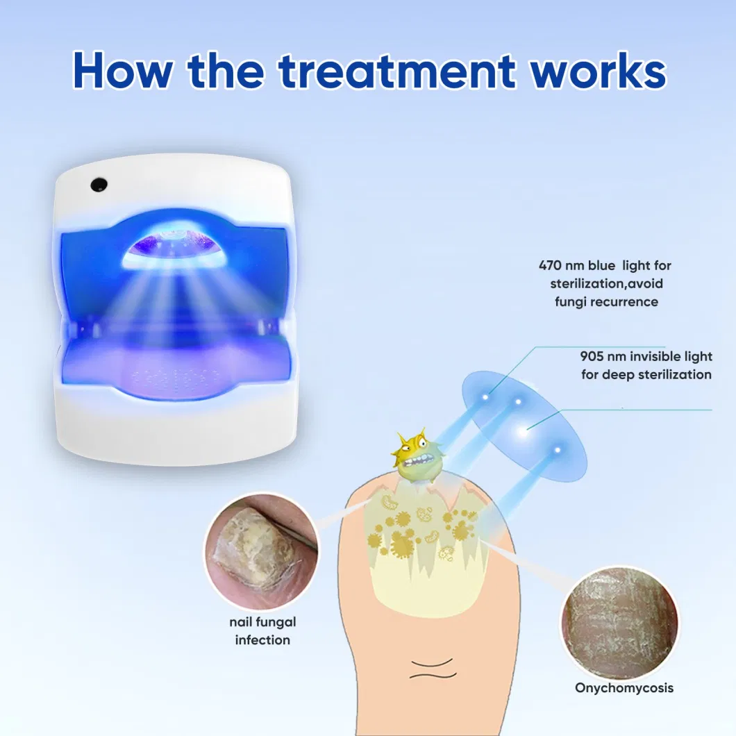 Cold Laser Therapy Device for Fungal Infections of Fingernails and Toes