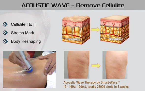 Acoustic Wave Therapy Focused Shock Wave Mini Shockwave Therapy Equipment