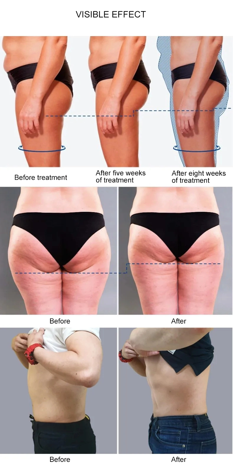 Focused System RF Shock Wave Eswt Shockwave Therapy Machines for Cellulite Reduction