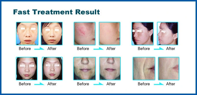 Effective Salon Use IPL Skin Acne Treatment with UK Lamp