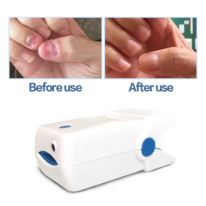 Lllt Cold Laser Nail Fungus Treatment Laser Therapy Device Nails Cleaning Physiotherapy Device