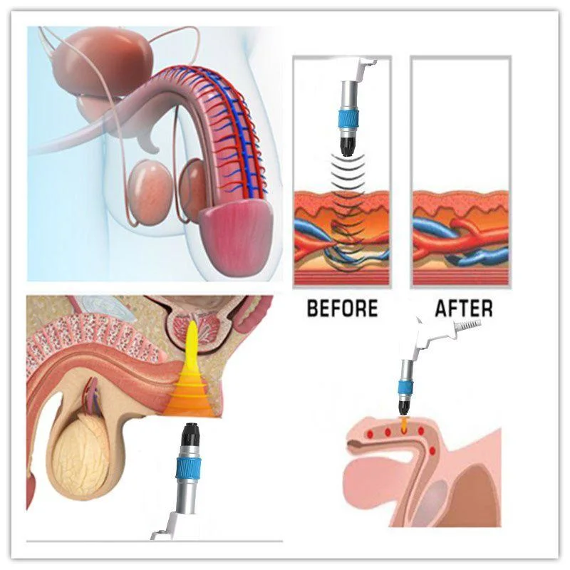 Portable Pneumatic Shockwave Machine for Body Pain Relief ED Treatment